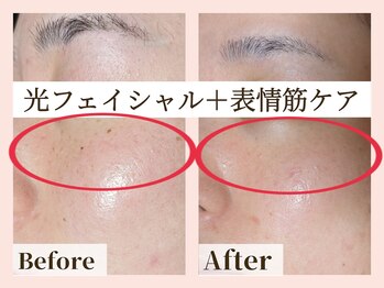 ラーナ(Lana)/表情筋ケア＋光