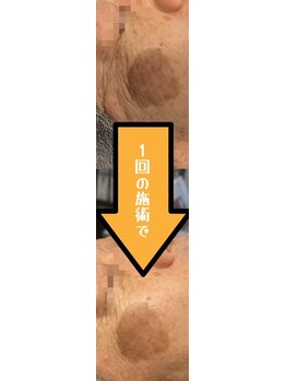 モルセラ(Moluccella)/1回の施術