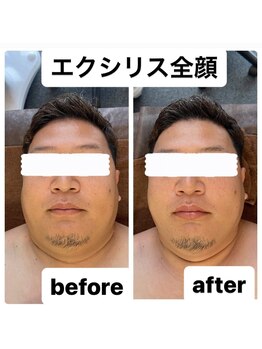 リベル(Liber)/小顔エクシリス