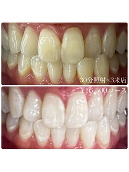 ホワイトニングルーム 横浜店(Whitening Room)/セルフホワイトニング/横浜