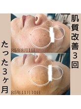 リーブル(LIBRE)/肌質改善　3回