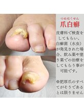 ドクターネイル爪革命 長野店/《施術不可能な場合の参考例》