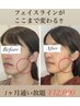 通い放題！小顔矯正orラジオ派EMS.リピート率90%以上の大人気メニュー！！