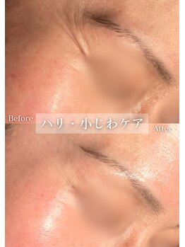 セレア(CELEA)/シミ・しわ改善／目の下のたるみ