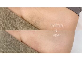 アウラ 表参道(AURA)/VIO脱毛