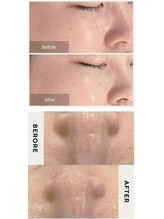 シエロ(Cielo)/陶肌ピールで陶器のような肌へ