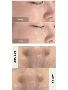 シエロ(Cielo)/陶肌ピールで陶器のような肌へ