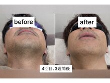 ラウラウ(laulau)