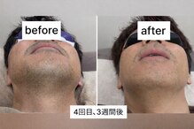 ラウラウ(laulau)