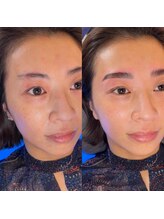 セレーノ(seReno)/HBL×ハイドロスプラッシュ