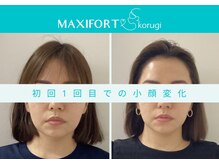 マキシフォート 名駅店(Maxifort)/初回１回目での小顔変化