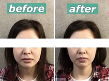 ボニー(Bonnie)/【トリプルリフトアップコース】