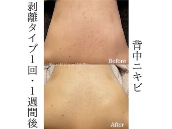 ビジュープラス 水戸店(Bijou+)/背中ニキビケア・1回