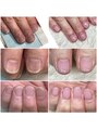 森のハナレ ユキケアサロン(YUKI care SALON) 深爪、丸い爪を、たて長に育てる名人です!いつでも来てね♪