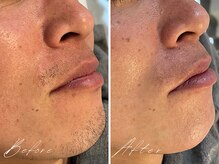 ミモア(mimoi.)/ヒゲWAX脱毛