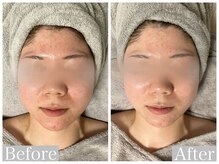 フルール(FLEUR)/アンストレス Before→After