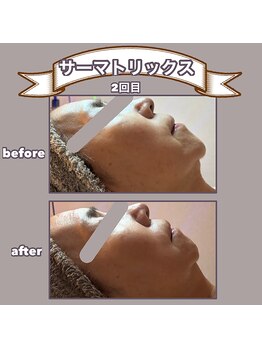 ビーマジック(美magic)/サーマトリックス