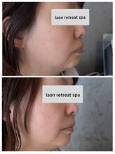 ラオン(laon)/トータルハイドラケア