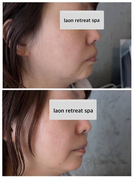 ラオン(laon)/トータルハイドラケア