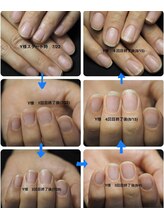 ビーハッピー(Be happy)/ネイルケアbefore after 
