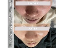 ブリリオプラス 広島並木店(Brillio Plus)の雰囲気（毛穴洗浄【ハイドラフェイシャル】なめらかなツルスベ毛穴へ♪）