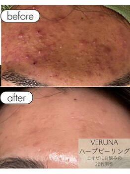 アルト(ALTO)の写真/【肌質改善に特化★】美肌を保つメニュー毛穴/たるみ/シミ改善/くすみ/フェイシャルもプロが施術致します!