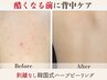 【背中魅せ徹底ケア】ハーブピーリング 背中全体