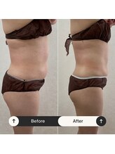 プレジール(PLAISIR)/キャビテーション腹部・ウエスト