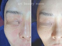 アート ビューティールーム(art beauty room)/☆エレクトロポレーション Ver1