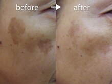 アルカンシエル(arcenciel)/シミ・シワ改善コース