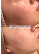 セレア(CELEA)/シミケア／陶器肌／シミ改善に