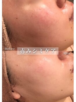 セレア(CELEA)/シミケア／陶器肌／シミ改善に