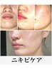 【ハーブピーリング】繰り返す大人ニキビ・ニキビ凹凸にお悩みの方　初回体験