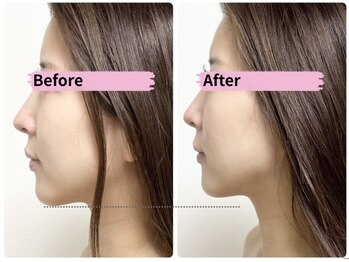 マリア(MALIA)/横顔美人◎小顔レモンボトル大阪