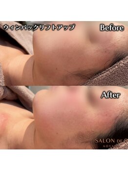 サロン ド エス アオヤマ(SALON DE S AOYAMA)/ウィンバックリフトアップ
