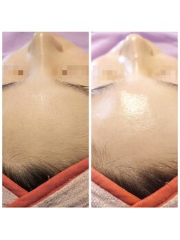 キアラ 麻布十番(Kiara)/顔ワックス脱毛/BeforeAfter