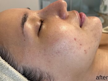 サロン ド エメ(salon de aimer)/【After】くすみ抜け・輪郭も♪