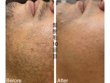 CDF 赤坂/メンズヒゲ脱毛10回目初回￥1000