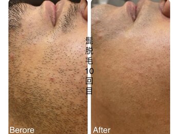 CDF 赤坂/メンズヒゲ脱毛10回目初回￥1000