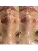 スピカ(Spica)/夏は毛穴ケア！