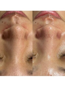 スピカ(Spica)/夏は毛穴ケア!