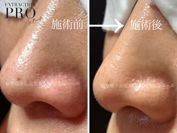 エール(aile)/毛穴ケアはプロにお任せ！