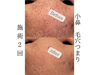ビジュープラス 水戸店(Bijou+)/鼻の黒ずみ改善