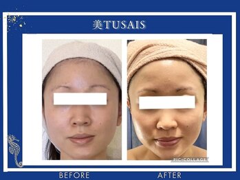 ビテュセ(美Tu sais)/小顔症例【小顔／松山／愛媛】