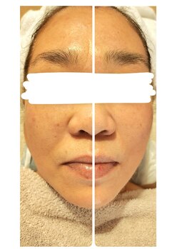 サロン ドゥ メビウス 春日店(salon de mebius)/小顔☆ほうれい線もスッキリ♪