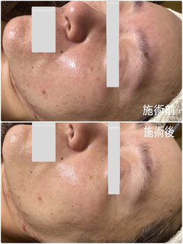 ブライトリー(Brightly)/月1サロンケアと自宅でコツコツ