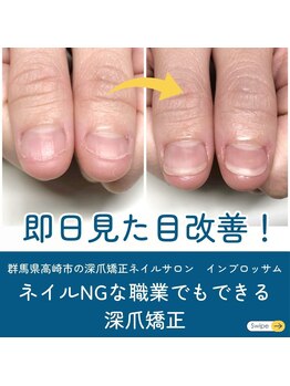 インブロッサム(imblossom)/見た目改善しながら深爪矯正