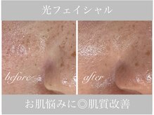 アリスビューティー(AliceBeauty)/光フェイシャル