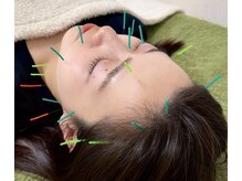 チキバンビューティーサロン/美容鍼で小顔リフトアップ♪