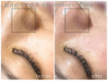 ラ ドゥーサ(La Dusa)/超音波毛穴洗浄☆いちご鼻改善